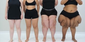 Dor, inchaço e vergonha: o sofrimento silencioso do lipedema45) 99947-0937